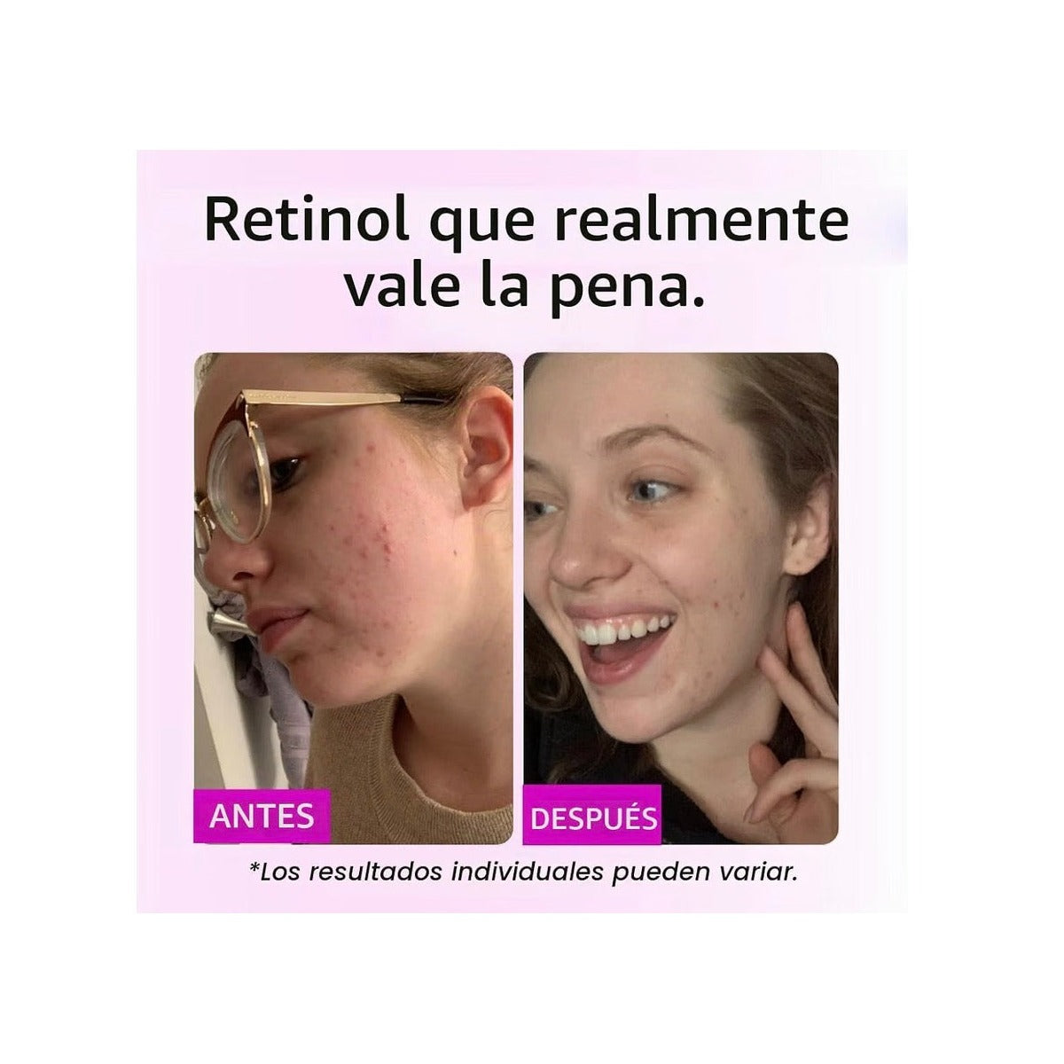 GLEOW Suero de Retinol para el Rostro con Ácido Hialurónico, el Retinol para el Rostro es Adecuado para Todo Tipo de Piel, Suero Hidratante para Mujeres y Hombres Rellena para una Apariencia Juvenil.